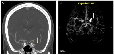 Impact of an automated large vessel occlusion detection tool on clinical workflow and patient outcomes